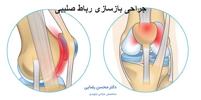 جراحی بازسازی رباط صلیبی