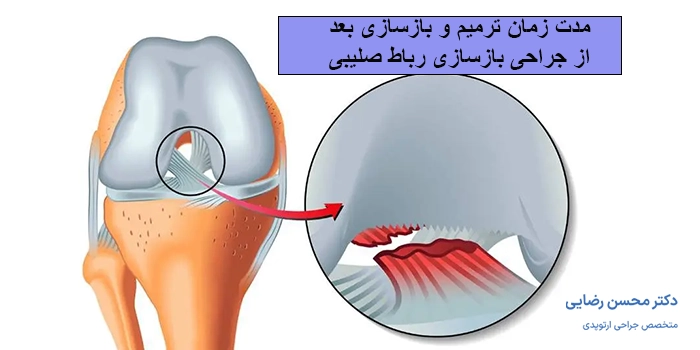 مدت زمان ترمیم و بازسازی بعد از جراحی بازسازی رباط صلیبی